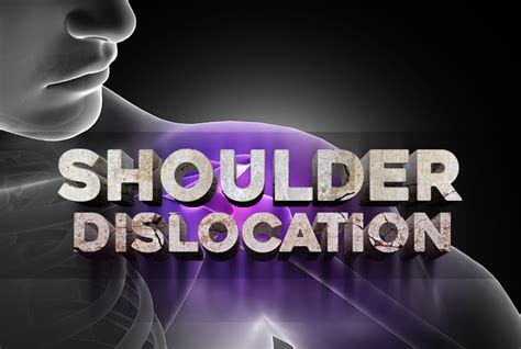 icd 10 shoulder dislocation|More.